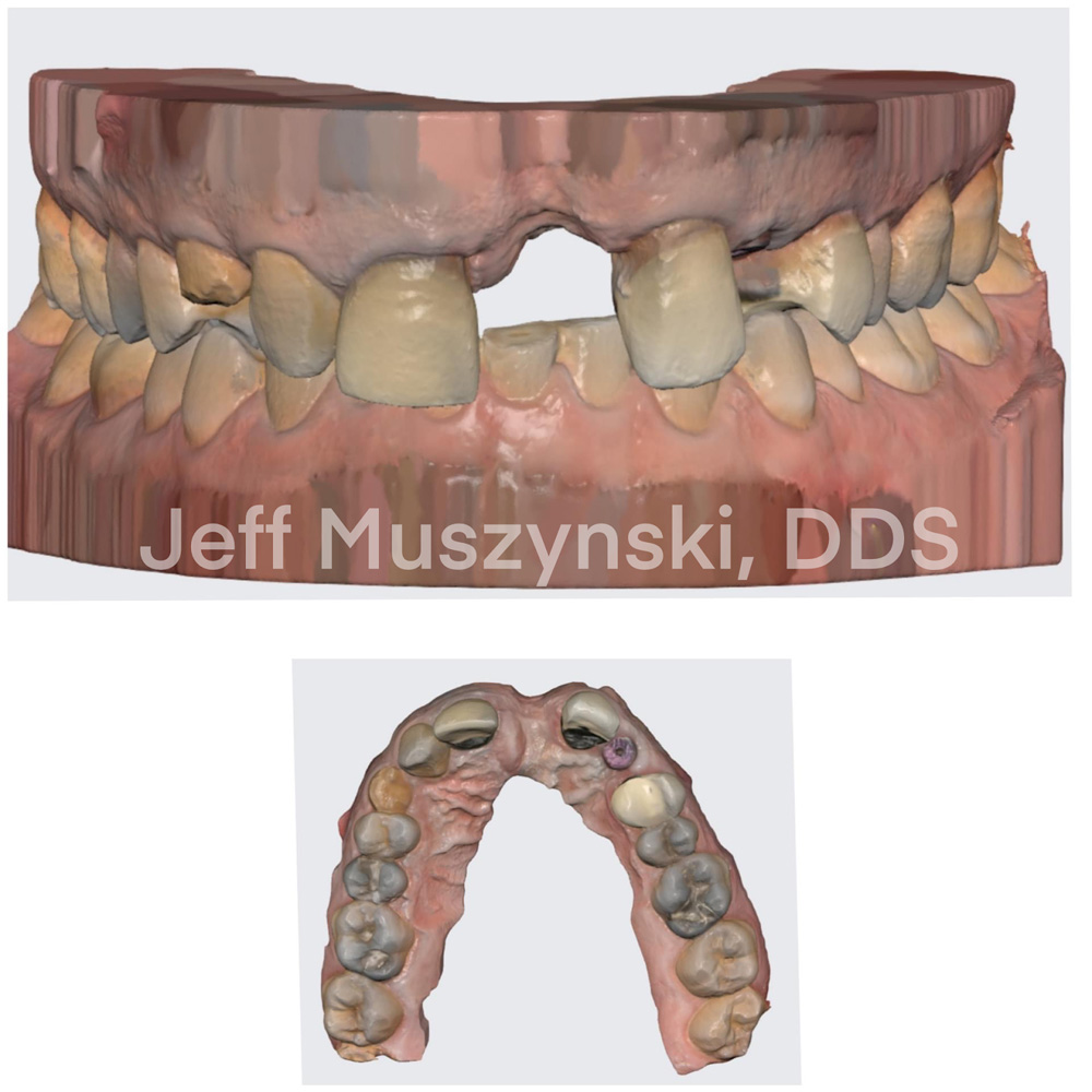 Treatment Planning for Complex Cases - Dental Implant Restoration
