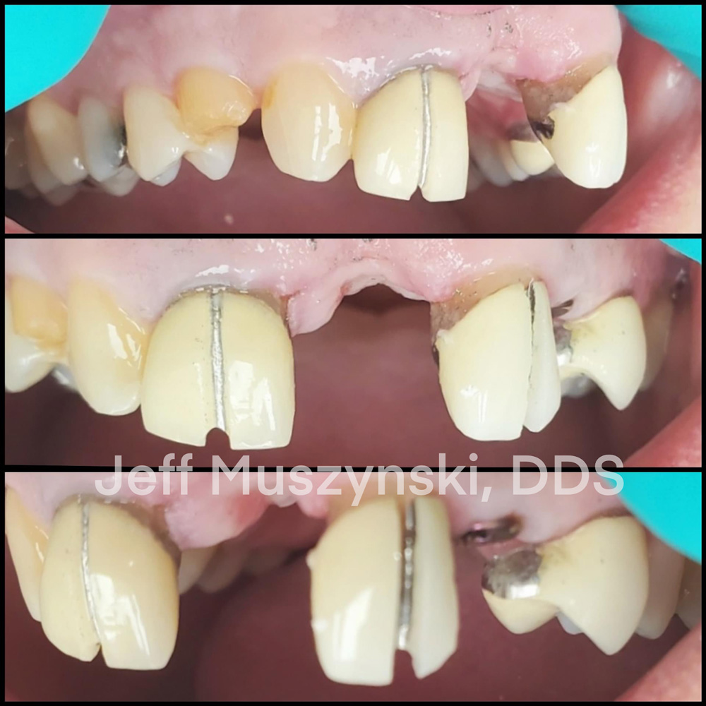 Treatment Planning for Complex Cases - Dental Implant Restoration