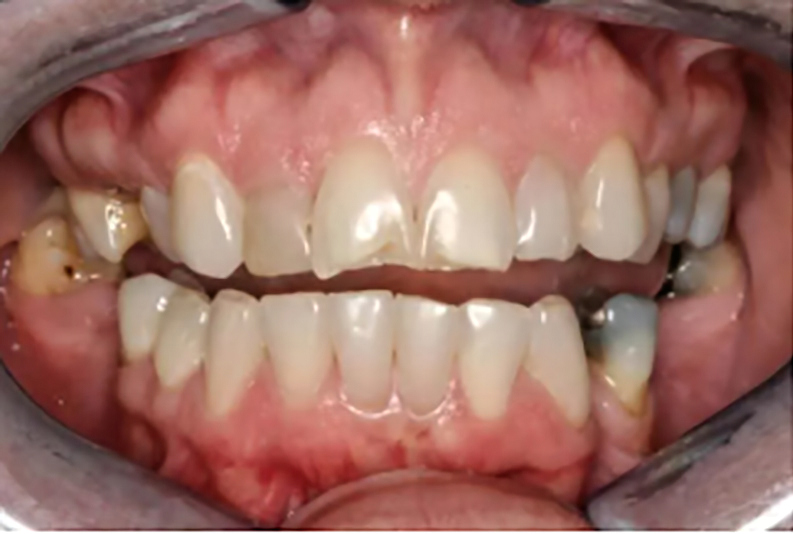 ZIRMAX M Full Mouth Rehabilitation Patient Examination