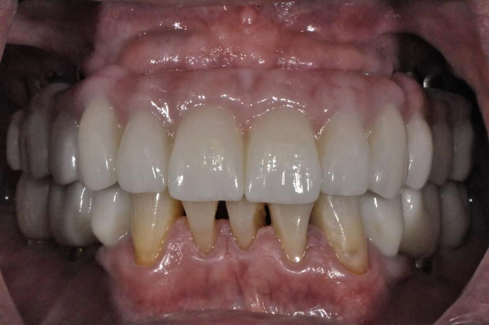 Dental Material - Zirconia vs. E.Max