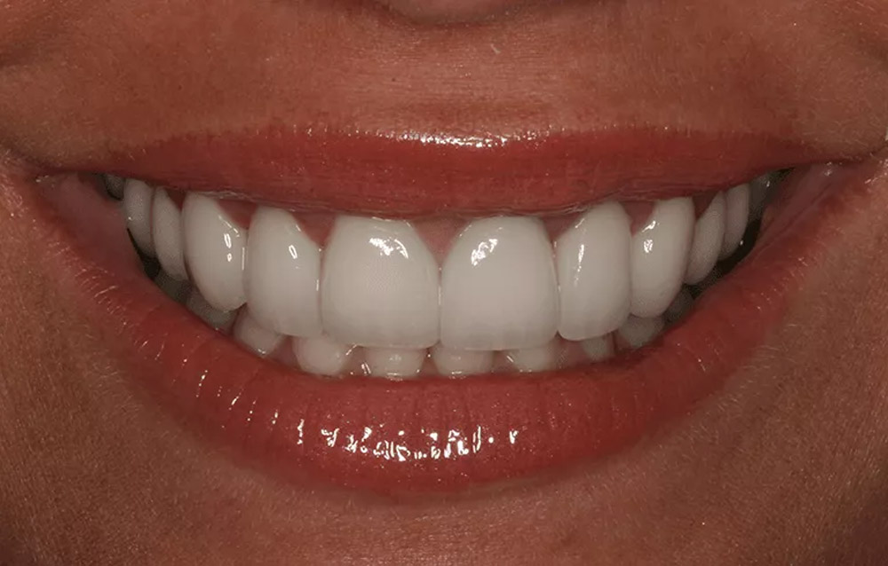 Dental Material - Zirconia vs. E.Max