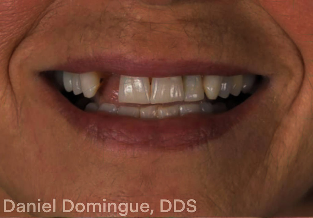anterior implant - Dr. Daniel Domingue