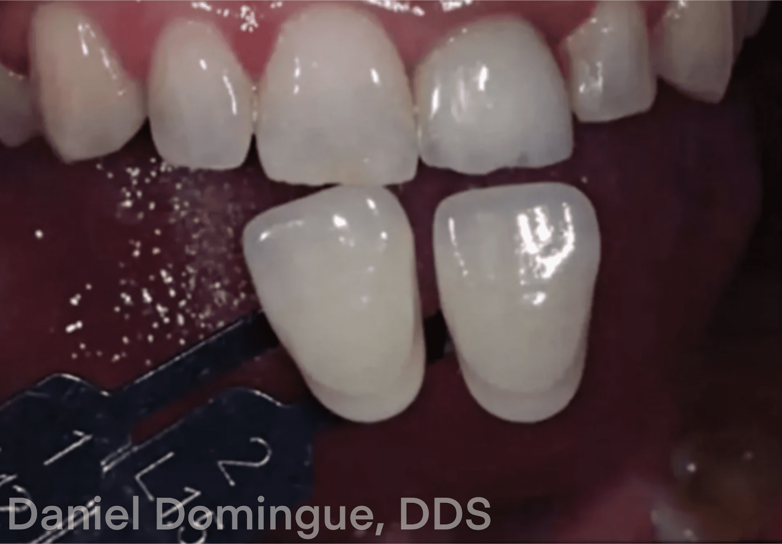 Place the incisal edge of the tab to the incisal edge of the tooth