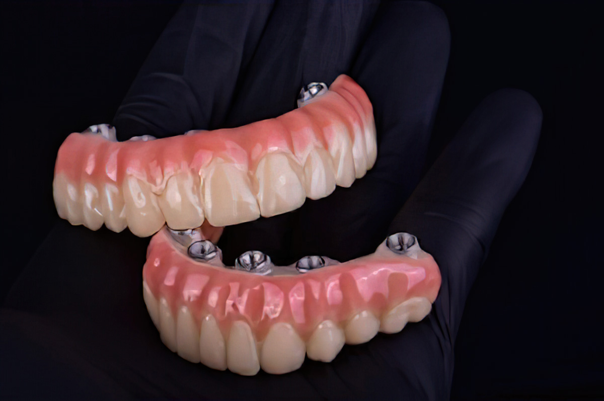 3D Implant Planning - Burbank Dental Lab - Los Angeles - Burbank