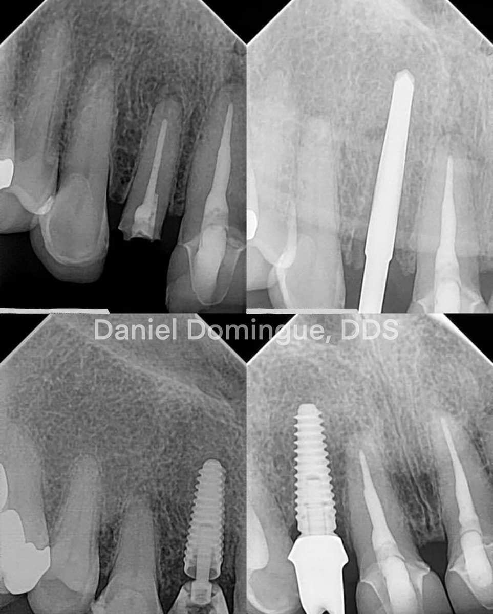 Implant Immediate Load: A Clinical Evaluation - ZIRMAX - SMART 1