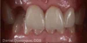 Implant Immediate Load: A Clinical Evaluation - ZIRMAX - SMART 1