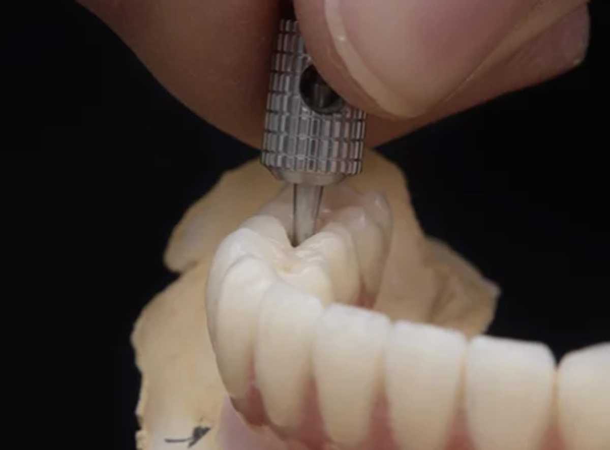 SMART 1 Porcelain Fused to CO/CR - Burbank Dental Lab