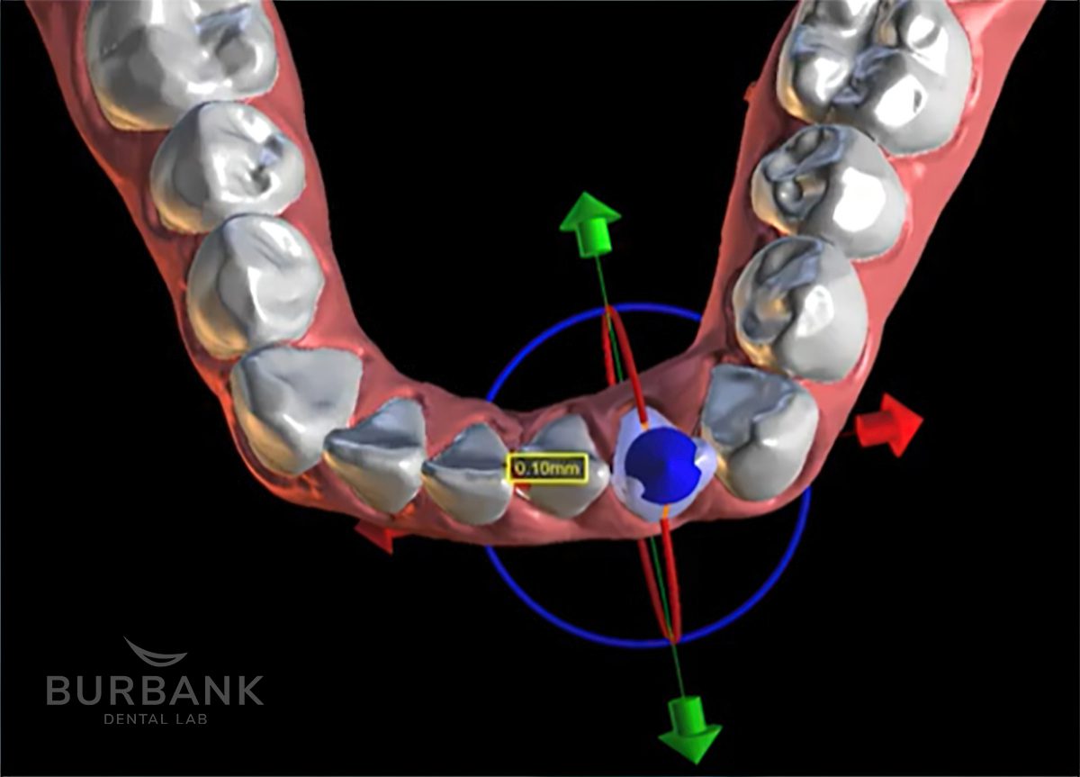 Clear Aligners for Orthodontic Tooth Movement - Burbank Dental Lab - Los Angeles - Burbank