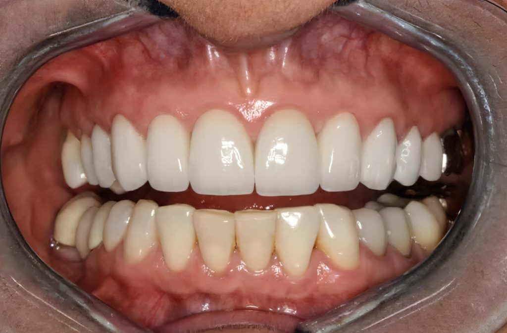 IPS e.max restorations - Burbank Dental Lab