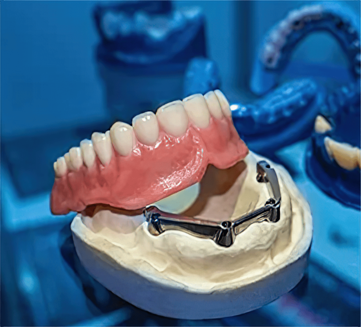 SMART 1 Milled Implant Bar Overdentures - Burbank Dental Lab - Los Angeles - Burbank