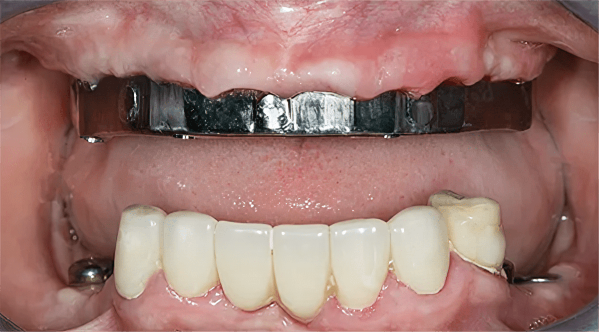 SMART 1 Milled Implant Bar Overdentures - Burbank Dental Lab - Los Angeles - Burbank