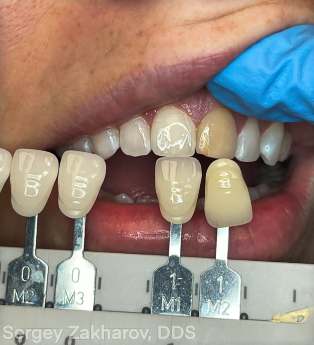 Matching A Central Incisor - Maxillary Central Incisor - Burbank Dental Lab - Los Angeles