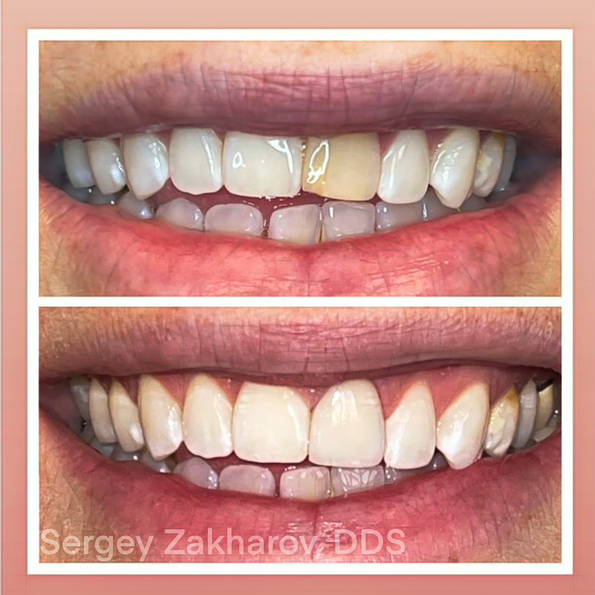 Matching A Central Incisor - Maxillary Central Incisor - Burbank Dental Lab - Los Angeles