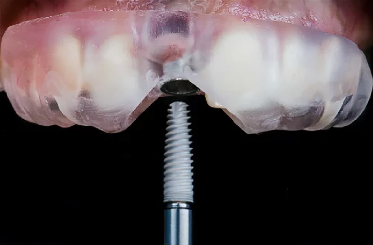 Dental Implant Placement: Freehand Implant Surgery vs. Guided Surgery - Burbank Dental Lab - Los Angeles, CA