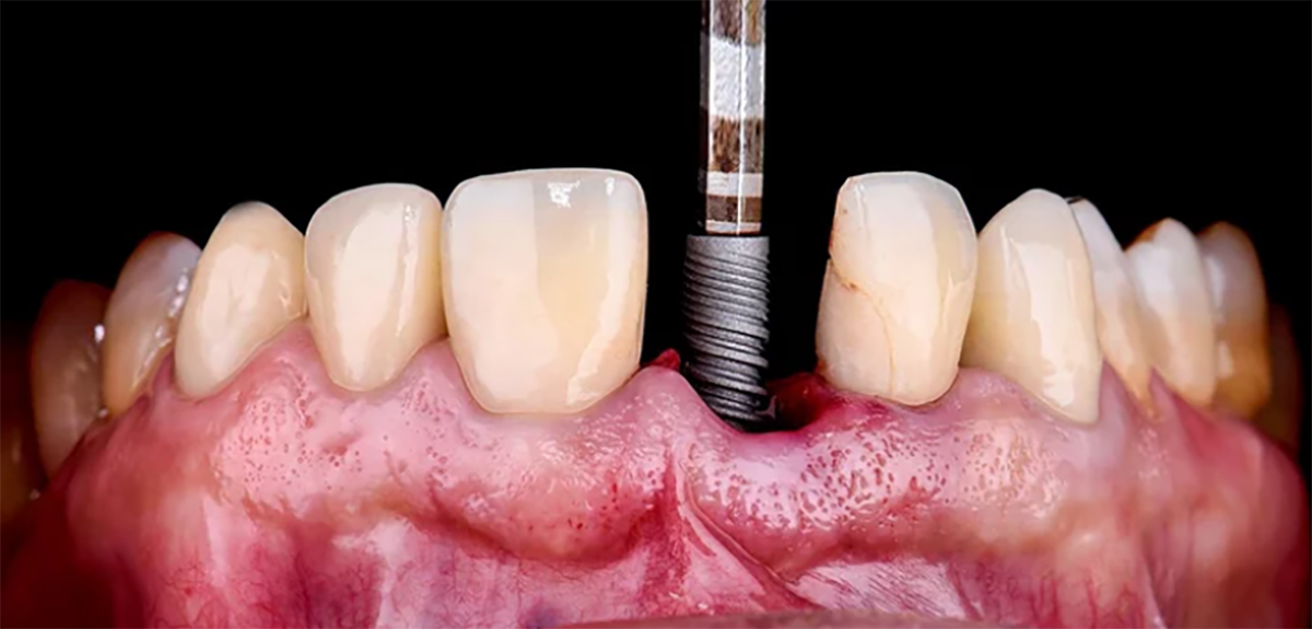 Dental Implant Placement: Freehand Implant Surgery vs. Guided Surgery - Burbank Dental Lab - Los Angeles, CA