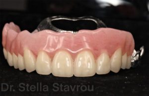 Case Study: Treating Edentulism with a Removable Partial Denture - Burbank Dental Lab - Burbank, Los Angeles