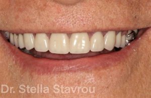 Case Study: Treating Edentulism with a Removable Partial Denture - Burbank Dental Lab - Burbank, Los Angeles
