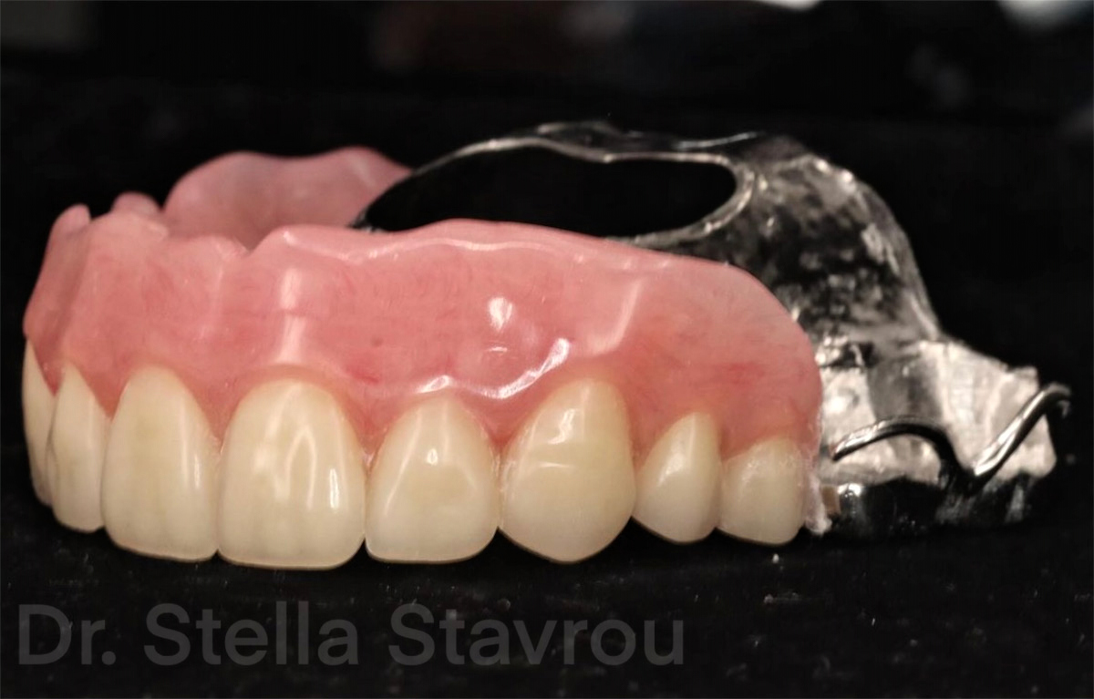 Case Study: Treating Edentulism with a Removable Partial Denture - Burbank Dental Lab - Burbank, Los Angeles