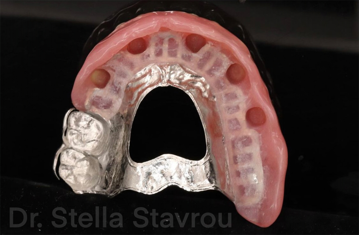 Case Study: Treating Edentulism with a Removable Partial Denture - Burbank Dental Lab - Burbank, Los Angeles