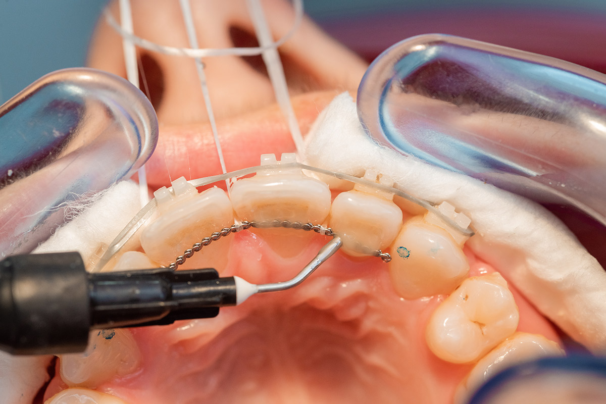 After Orthodontic Treatment: Fixed Retainer, Removable Retainer - Burbank Dental Lab