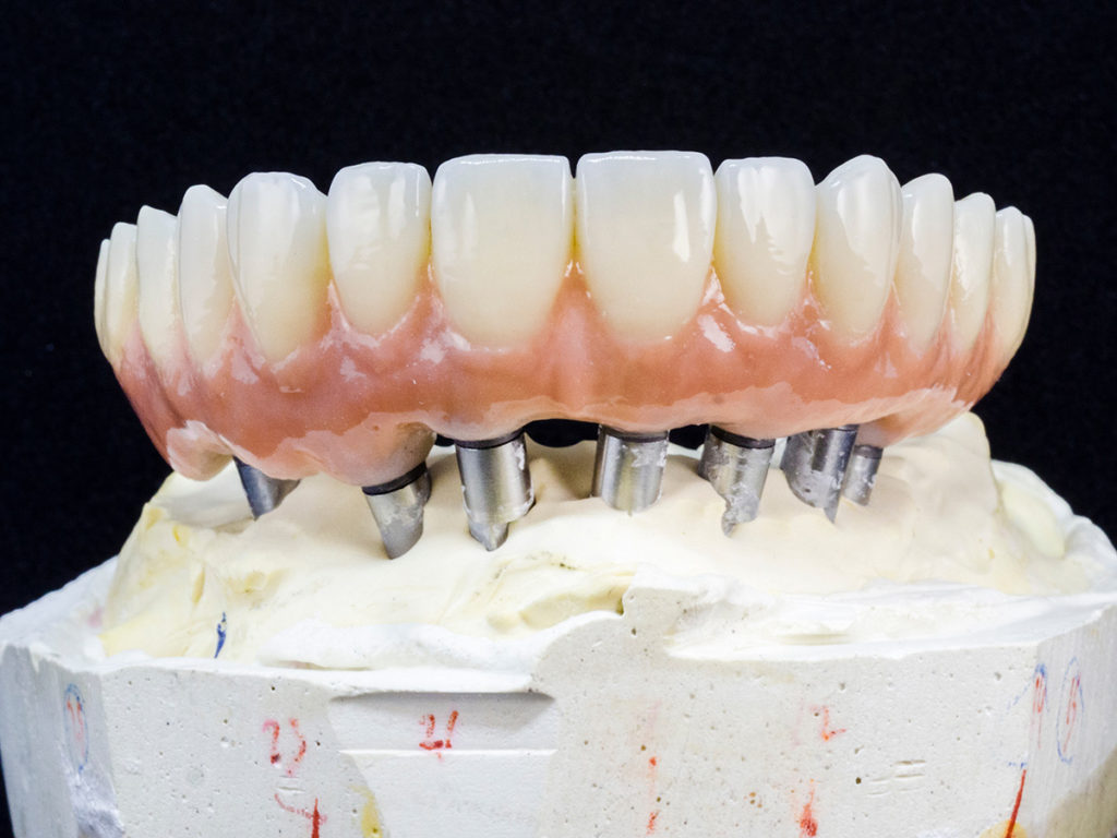 ZIRMAX M: Implant Supported Fixed Prosthesis