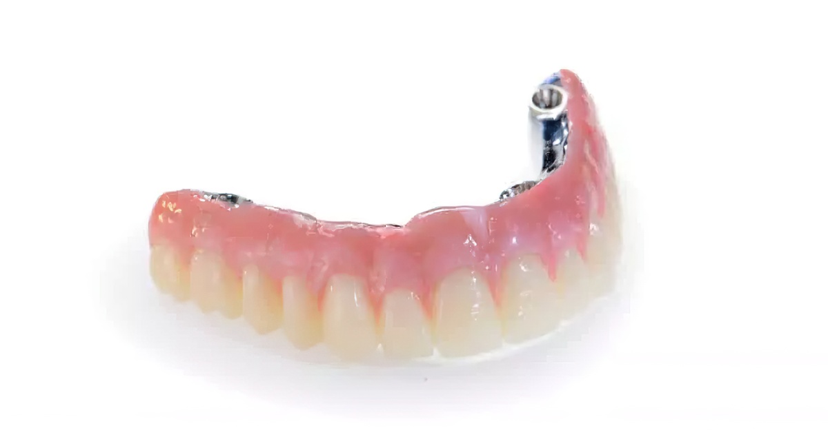 SmartComposite: When is composite the best option? - Burbank Dental Lab