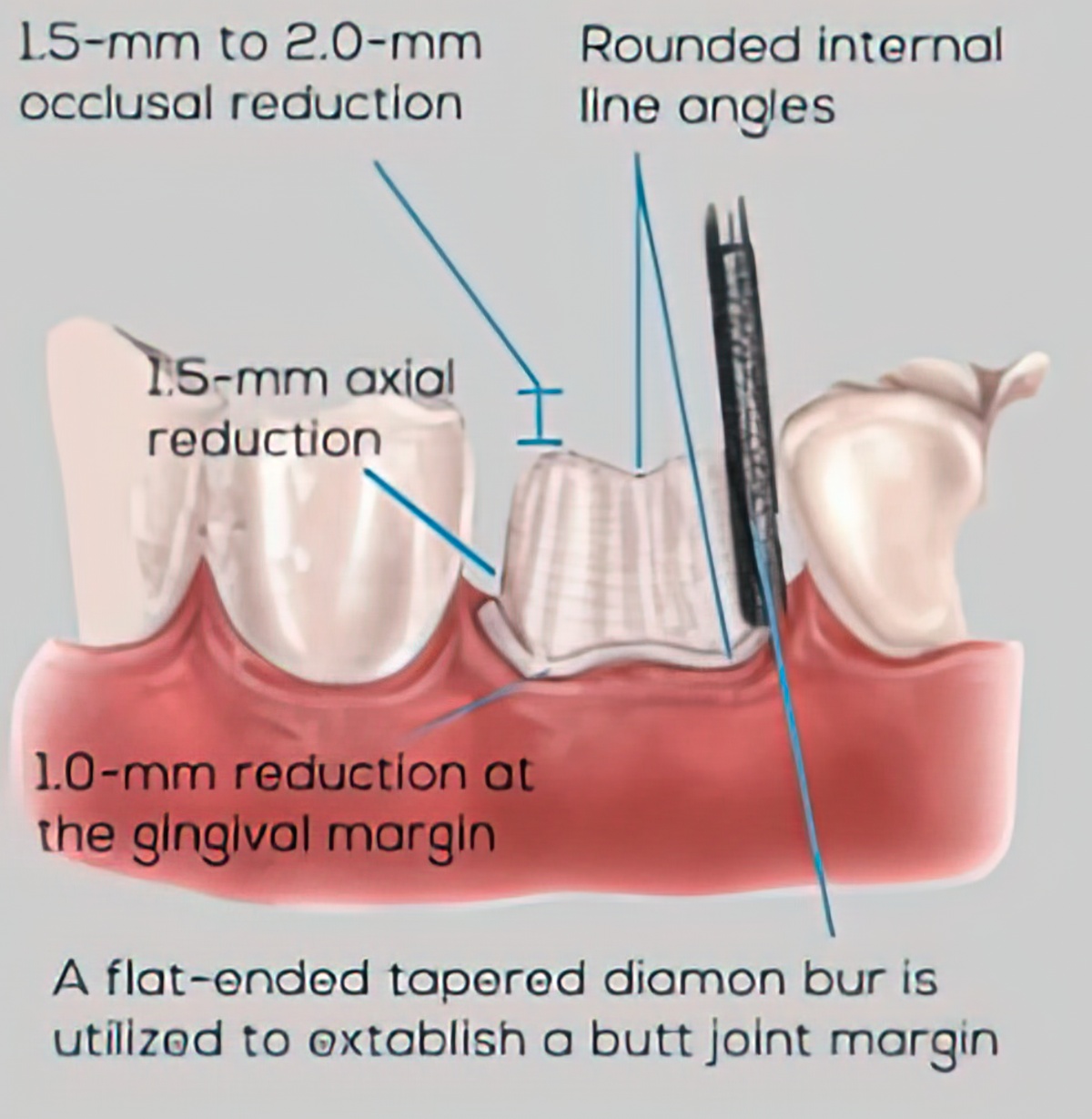 Improve Zirconia Restorations - Burbank Dental Lab