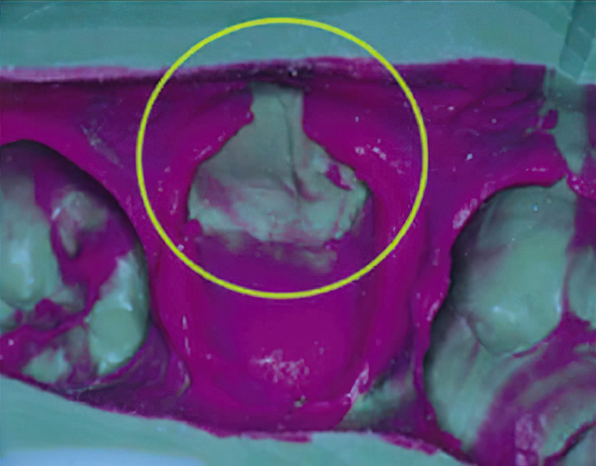 Methods for Traditional Dental Impressions: The Foundation of Restorations
