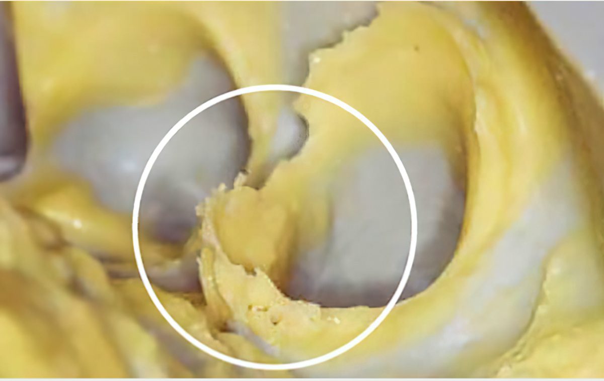 Methods for Traditional Dental Impressions: The Foundation of Restorations