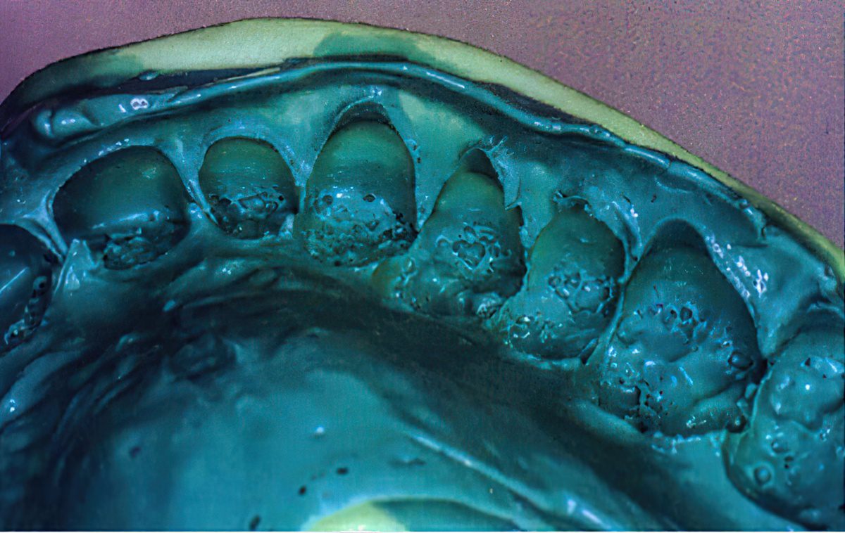 Methods for Traditional Dental Impressions: The Foundation of Restorations