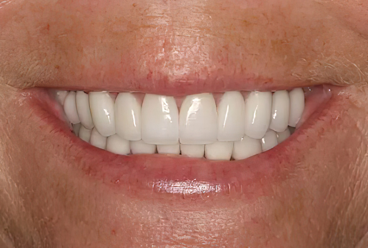 Full Mouth Rehabilitation - Burbank Dental Lab