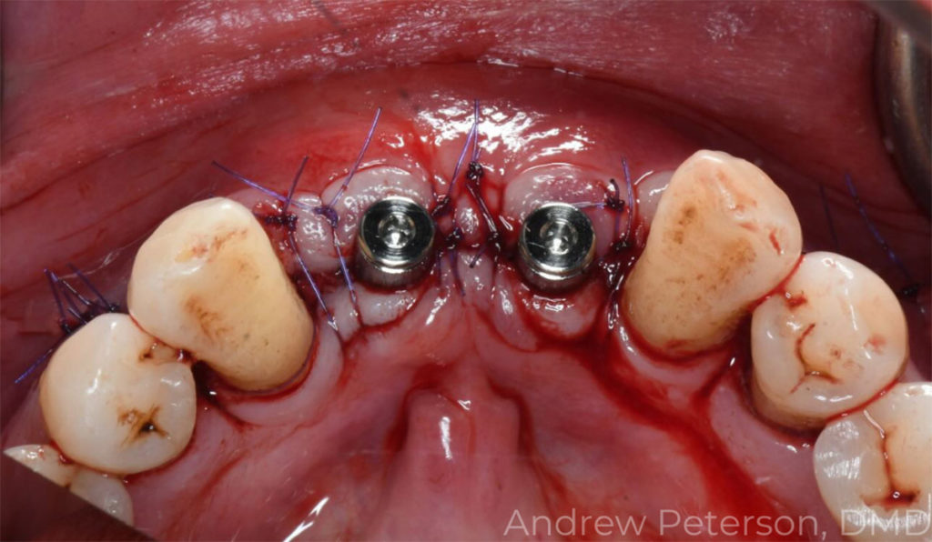 Case Study: Implant Placement and Provisionalization in Advanced Gum Disease Patient - by Dr. Andrew Petersn, DMD, MS - with Burbank Dental Lab - Burbank CA