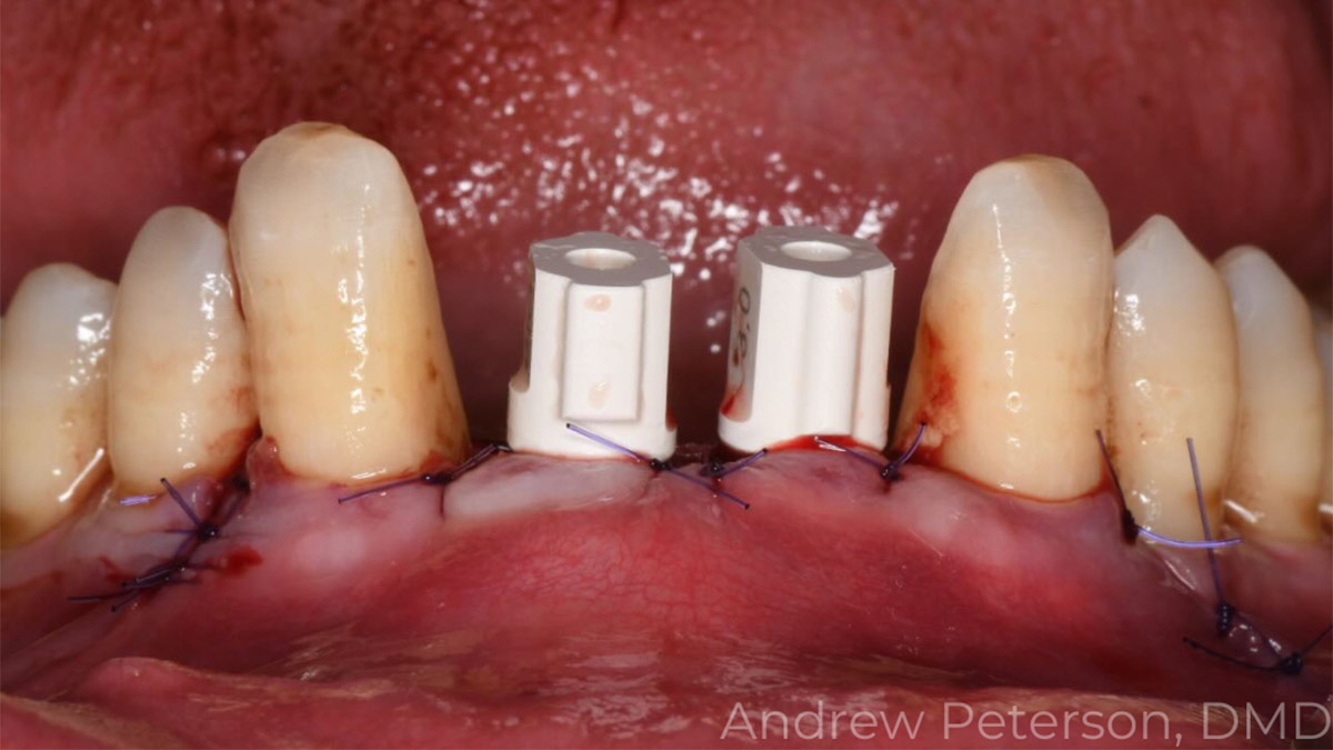Case Study: Implant Placement and Provisionalization in Advanced Gum Disease Patient - by Dr. Andrew Petersn, DMD, MS - with Burbank Dental Lab - Burbank CA