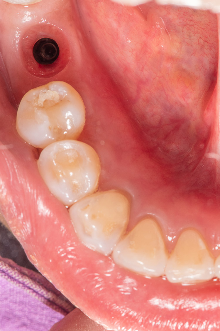 Improving Implant Success Using Custom Healing Abutments - Burbank Dental Lab