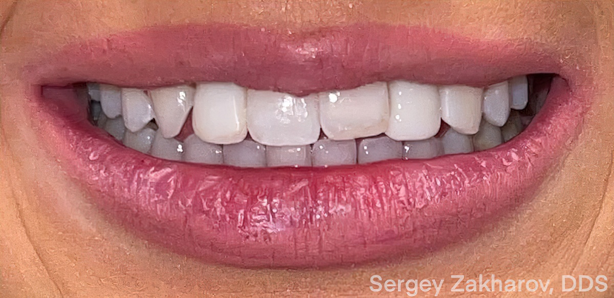 Smiles By Design: E.max Case Study with Dr. Sergey Zakharov of Family Dentistry at Riverside Crossing