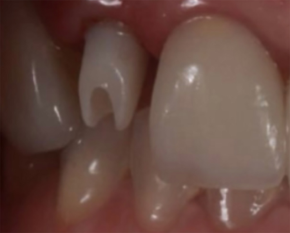 Dental Implants: SMART 1 Implant Options at Burbank Dental Lab