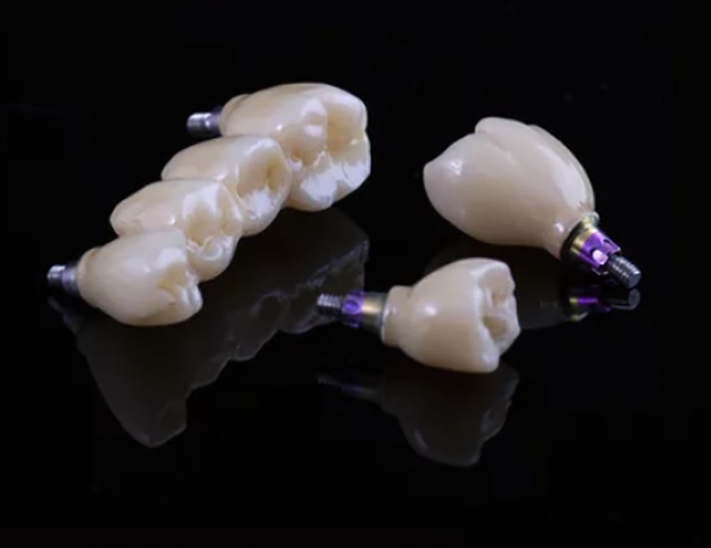 Dental Implants: SMART 1 Implant Options at Burbank Dental Lab