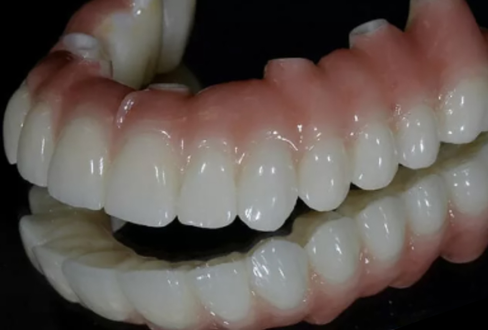 Successful Prosthetic Treatments: The Importance of Provisionals - Burbank Dental Lab - California