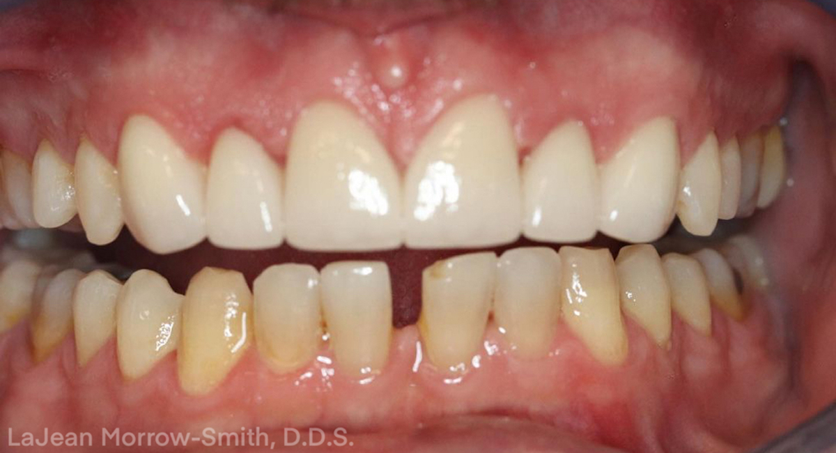 Layered Emax for Improved Esthetics - Burbank Dental Lab - California