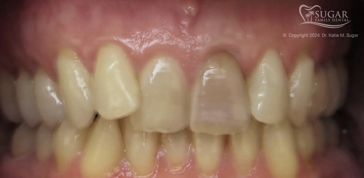 Masking An Endodontically Treated Tooth - Burbank Dental Lab California
