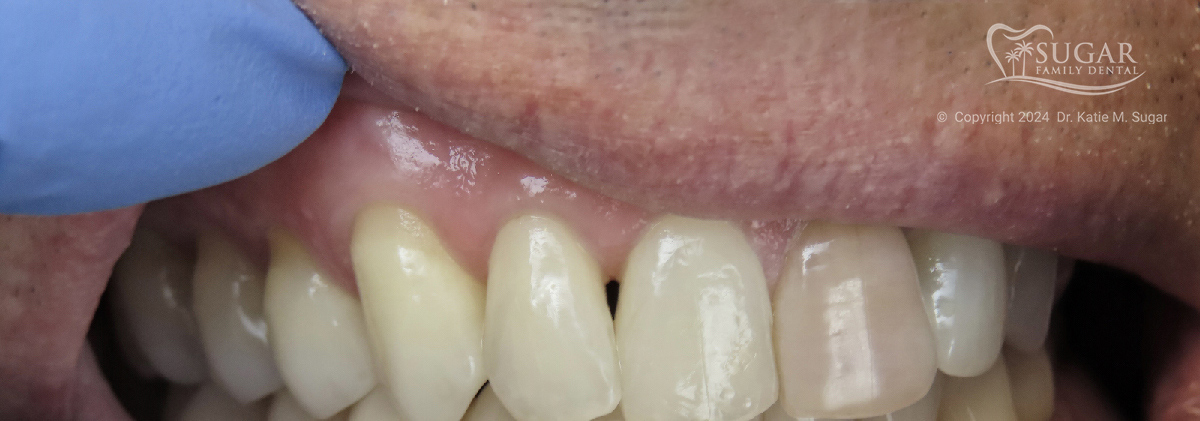 Masking An Endodontically Treated Tooth - Burbank Dental Lab California