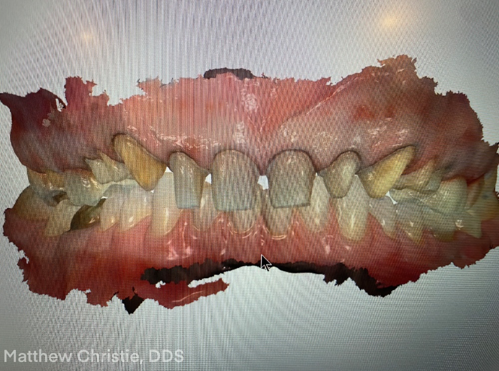 Clear Communication: An E.MAX Case Study - Burbank Dental Lab - California