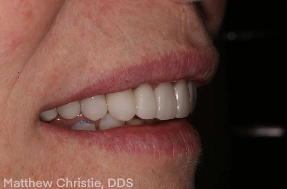 The Benefits of E.MAX Restoration - Burbank Dental Lab - Calilfornia