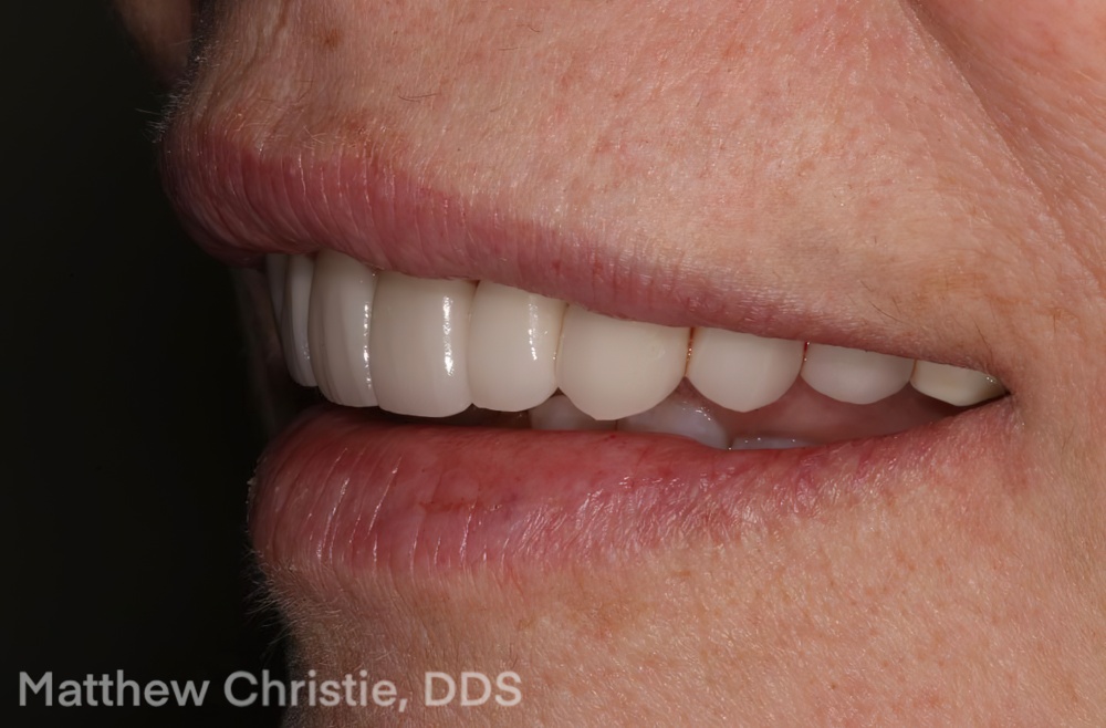 The Benefits of E.MAX Restoration - Burbank Dental Lab - Calilfornia