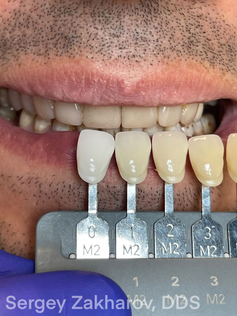 Material Selection for Optimal Dental Veneer Results: A Case Study - Burbank Dental Lab