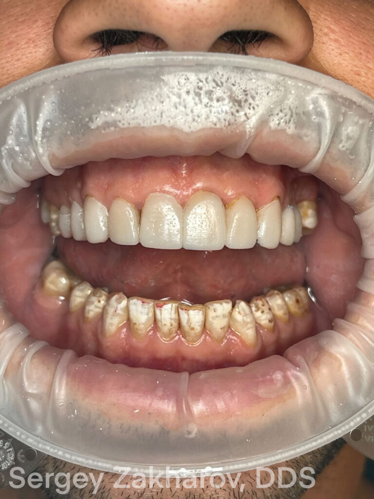 Material Selection for Optimal Dental Veneer Results: A Case Study - Burbank Dental Lab