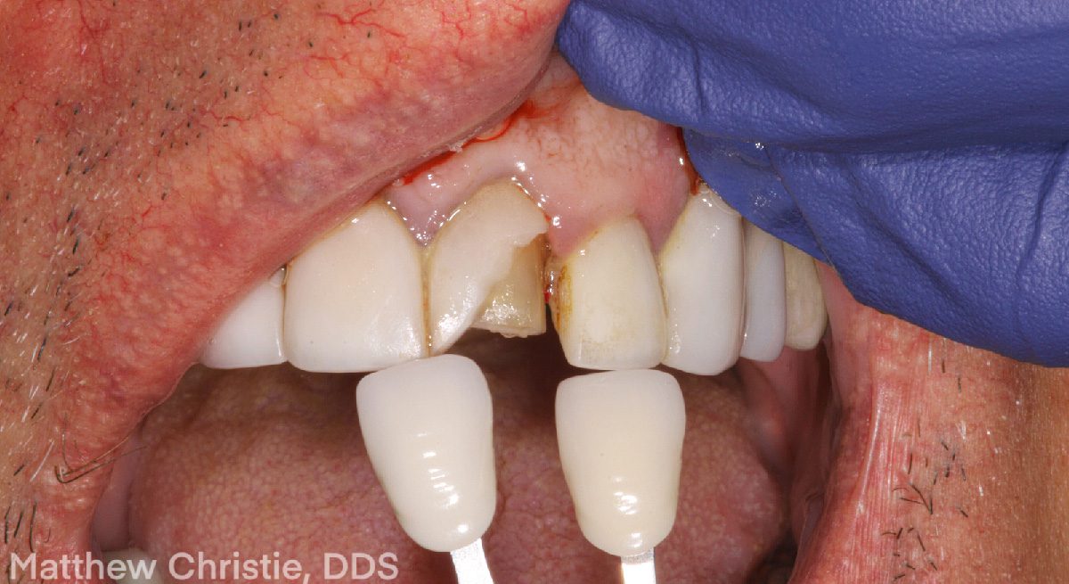 Single Central: Information is Key - Burbank Dental Lab - California