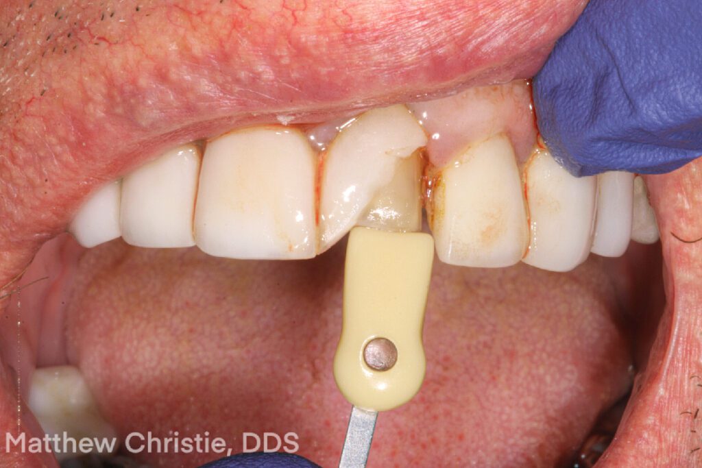 Single Central: Information is Key - Burbank Dental Lab - California