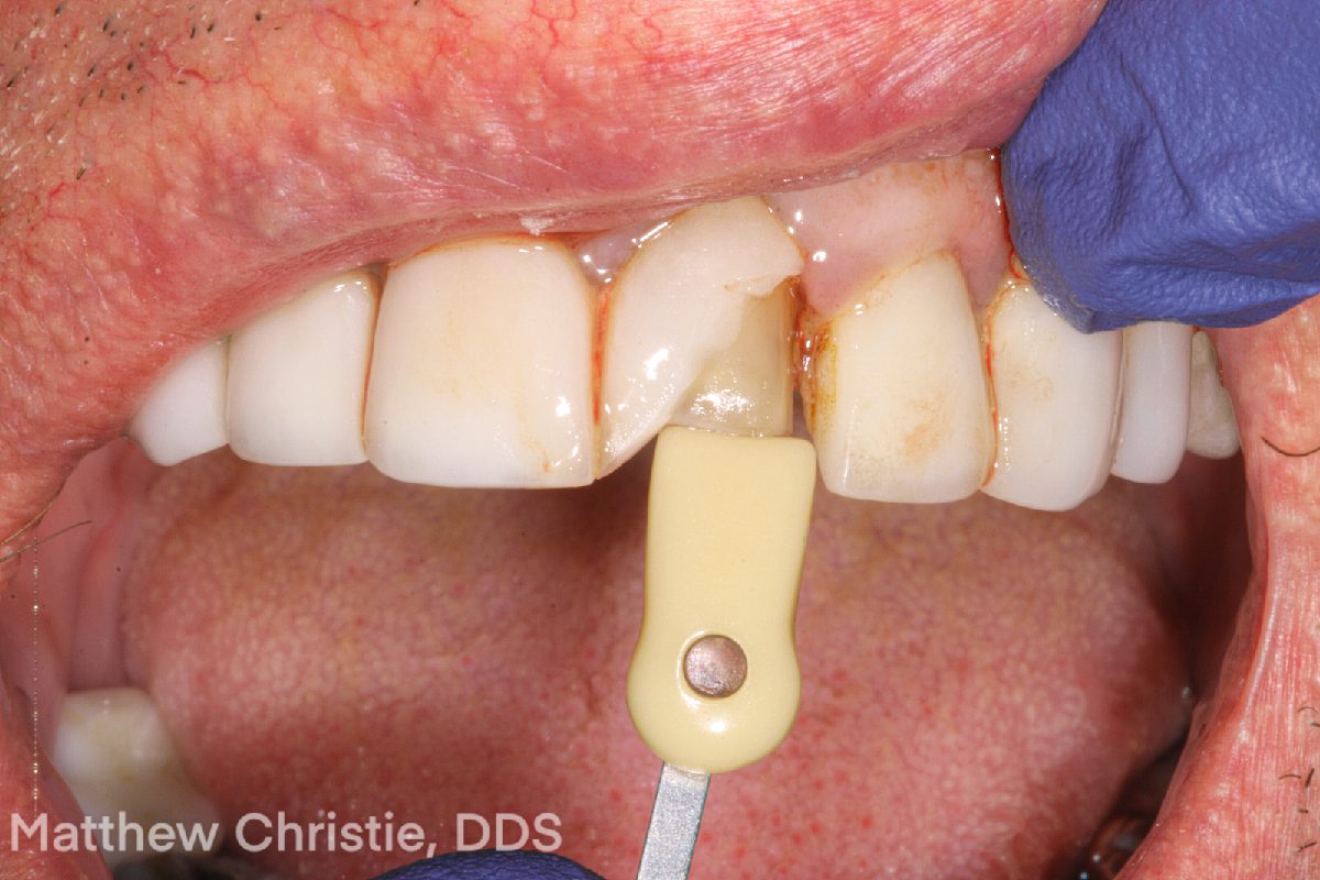 Single Central Restorations: Why Complete Case Information Is the Deciding Factor - Burbank Dental Lab - CA