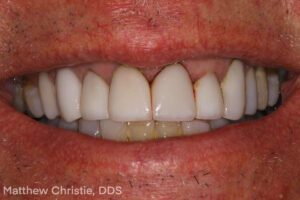 Single Central Restorations: Why Complete Case Information Is the Deciding Factor - Burbank Dental Lab - CA